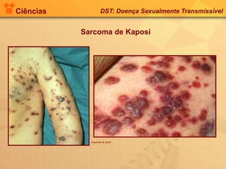 Ciências DST: Doença Sexualmente Transmissível
Sarcoma de Kaposi
Arquivos do autor
 
