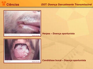 Ciências DST: Doença Sexualmente Transmissível
Herpes – Doença oportunista
Candidíase bucal – Doença oportunista
Arquivo do autor
Arquivo do autor
 