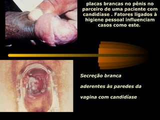 placas brancas no pênis no
parceiro de uma paciente com
candidíase . Fatores ligados à
 higiene pessoal influenciam
      casos como este.




Secreção branca

aderentes às paredes da

vagina com candidíase   .
 