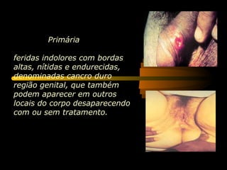 Primária

feridas indolores com bordas
altas, nítidas e endurecidas,
denominadas cancro duro
região genital, que também
podem aparecer em outros
locais do corpo desaparecendo
com ou sem tratamento.
 