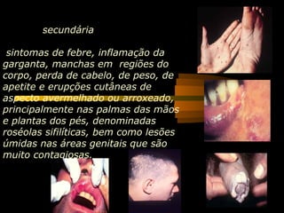 secundária

 sintomas de febre, inflamação da
garganta, manchas em regiões do
corpo, perda de cabelo, de peso, de
apetite e erupções cutâneas de
aspecto avermelhado ou arroxeado,
principalmente nas palmas das mãos
e plantas dos pés, denominadas
roséolas sifilíticas, bem como lesões
úmidas nas áreas genitais que são
muito contagiosas.
 
