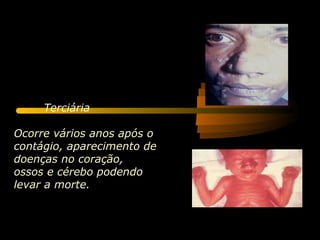 Terciária

Ocorre vários anos após o
contágio, aparecimento de
doenças no coração,
ossos e cérebo podendo
levar a morte.
 
