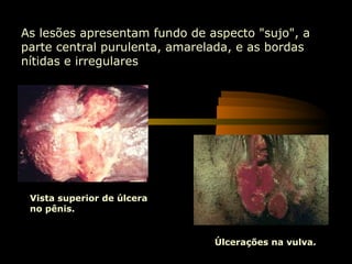 As lesões apresentam fundo de aspecto "sujo", a
parte central purulenta, amarelada, e as bordas
nítidas e irregulares




 Vista superior de úlcera
 no pênis.


                               Úlcerações na vulva.
 