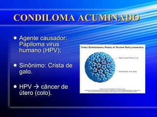 CONDILOMA ACUMINADO Agente causador: Papiloma virus humano (HPV); Sinônimo: Crista de galo. HPV    câncer de útero (colo). 