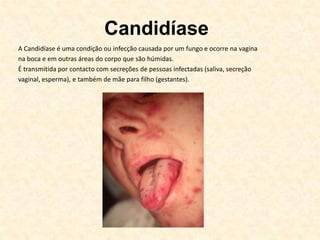 Condiloma acuminado / HPV