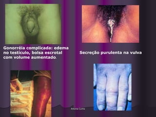 Gonorréia complicada: edema
no testículo, bolsa escrotal          Secreção purulenta na vulva
com volume aumentado.




                               Antonia Cunha
 