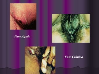 Fase Aguda




                             Fase Crônica


             Antonia Cunha
 