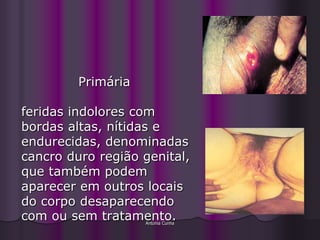 Primária

feridas indolores com
bordas altas, nítidas e
endurecidas, denominadas
cancro duro região genital,
que também podem
aparecer em outros locais
do corpo desaparecendo
com ou sem tratamento.
                    Antonia Cunha
 