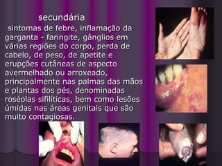 secundária
 sintomas de febre, inflamação da
garganta - faringite, gânglios em
várias regiões do corpo, perda de
cabelo, de peso, de apetite e
erupções cutâneas de aspecto
avermelhado ou arroxeado,
principalmente nas palmas das mãos
e plantas dos pés, denominadas
roséolas sifilíticas, bem como lesões
úmidas nas áreas genitais que são
muito contagiosas.



                         Antonia Cunha
 