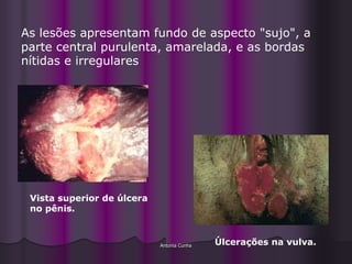 As lesões apresentam fundo de aspecto "sujo", a
parte central purulenta, amarelada, e as bordas
nítidas e irregulares




 Vista superior de úlcera
 no pênis.



                            Antonia Cunha   Úlcerações na vulva.
 