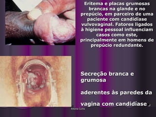Eritema e placas grumosas
            brancas na glande e no
        prepúcio, em parceiro de uma
           paciente com candidíase
        vulvovaginal. Fatores ligados
        à higiene pessoal influenciam
               casos como este,
        principalmente em homens de
             prepúcio redundante.




        Secreção branca e
        grumosa

        aderentes às paredes da

        vagina com candidíase
Antonia Cunha
                                  .
 