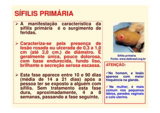 A manifestação característica da
sífilis primária é o surgimento de
feridas.
 Caracteriza-se pela presença de
lesão rosada ou ulcerada de 0,3 a 1,0
cm (até 2,0 cm.) de diâmetro. É
geralmente única, pouco dolorosa,
com base endurecida, fundo liso,
brilhante e secreção serosa escassa.
 Esta fase aparece entre 10 e 90 dias
(média de 14 a 21 dias) após a
pessoa ter se exposto a alguém com
sífilis. Sem tratamento esta fase
dura, aproximadamente, 4 a 8
semanas, passando a fase seguinte.
Sífilis primária
Fonte: www.dstbrasil.org.br
SÍFILIS PRIMÁRIA
ATENÇÃO:
No homem, a lesão
aparece com maior
frequência na glande.
 Na mulher, é mais
comum nos pequenos
lábios, paredes vaginais
e colo uterino.
 