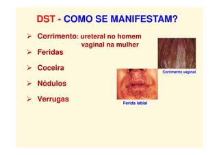 Corrimento: ureteral no homem
vaginal na mulher
 Feridas
 Coceira
 Nódulos
 Verrugas
DST - COMO SE MANIFESTAM?
Corrimento vaginal
Ferida labial
 