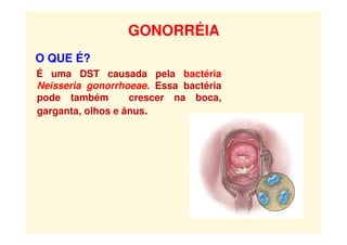 GONORRÉIA
O QUE É?
É uma DST causada pela bactéria
Neisseria gonorrhoeae. Essa bactéria
pode também crescer na boca,
garganta, olhos e ânus.
 
