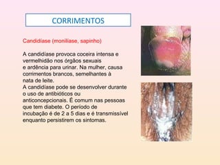Candidíase (monilíase, sapinho)
A candidíase provoca coceira intensa e
vermelhidão nos órgãos sexuais
e ardência para urinar. Na mulher, causa
corrimentos brancos, semelhantes à
nata de leite.
A candidíase pode se desenvolver durante
o uso de antibióticos ou
anticoncepcionais. É comum nas pessoas
que tem diabete. O período de
incubação é de 2 a 5 dias e é transmissível
enquanto persistirem os sintomas.
CORRIMENTOS
 
