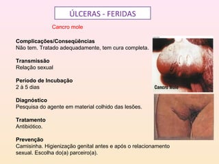 ÚLCERAS - FERIDAS
Cancro mole
Complicações/Conseqüências
Não tem. Tratado adequadamente, tem cura completa.
Transmissão
Relação sexual
Período de Incubação
2 à 5 dias
Diagnóstico
Pesquisa do agente em material colhido das lesões.
Tratamento
Antibiótico.
Prevenção
Camisinha. Higienização genital antes e após o relacionamento
sexual. Escolha do(a) parceiro(a).
 