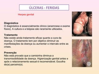 ÚLCERAS - FERIDAS
Herpes genital
Diagnóstico
O diagnóstico é essencialmente clínico (anamnese e exame
físico). A cultura e a biópsia são raramente utilizados.
Tratamento
Não existe ainda tratamento eficaz quanto a cura da
doença. O tratamento tem por objetivo diminuir as
manifestações da doença ou aumentar o intervalo entre as
crises.
Prevenção
Não está provado que a camisinha diminua a
transmissibilidade da doença. Higienização genital antes e
após o relacionamento sexual é recomendável. Escolha
do(a) parceiro(a).
 