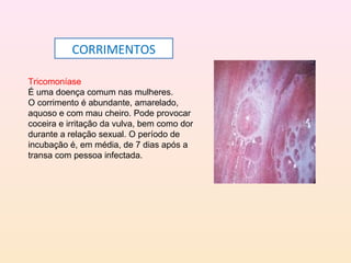 Tricomoníase
É uma doença comum nas mulheres.
O corrimento é abundante, amarelado,
aquoso e com mau cheiro. Pode provocar
coceira e irritação da vulva, bem como dor
durante a relação sexual. O período de
incubação é, em média, de 7 dias após a
transa com pessoa infectada.
CORRIMENTOS
 