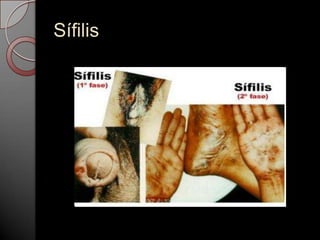 Sífilis

 
