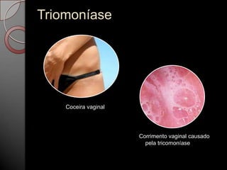 Triomoníase

Coceira vaginal

Corrimento vaginal causado
pela tricomoníase

 