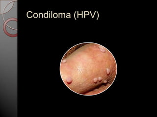 Condiloma (HPV)

 