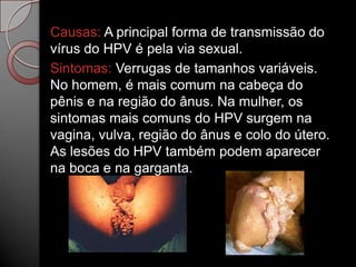 Causas: A principal forma de transmissão do
vírus do HPV é pela via sexual.
Sintomas: Verrugas de tamanhos variáveis.
No homem, é mais comum na cabeça do
pênis e na região do ânus. Na mulher, os
sintomas mais comuns do HPV surgem na
vagina, vulva, região do ânus e colo do útero.
As lesões do HPV também podem aparecer
na boca e na garganta.

 