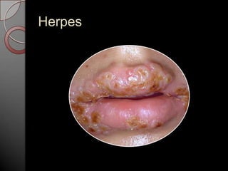 Herpes

 