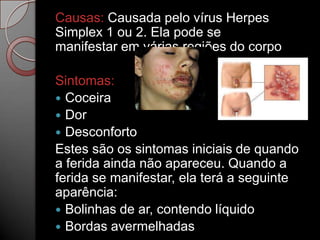 Causas: Causada pelo vírus Herpes
Simplex 1 ou 2. Ela pode se
manifestar em várias regiões do corpo
Sintomas:
 Coceira
 Dor
 Desconforto
Estes são os sintomas iniciais de quando
a ferida ainda não apareceu. Quando a
ferida se manifestar, ela terá a seguinte
aparência:
 Bolinhas de ar, contendo líquido
 Bordas avermelhadas

 