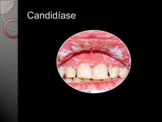 Candidíase

 