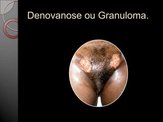 Denovanose ou Granuloma.

 