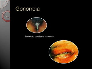 Gonorreia

Secreção purulenta na vulva

 