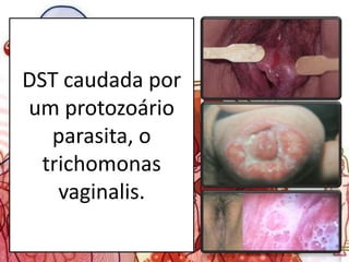 DST caudada por
um protozoário
parasita, o
trichomonas
vaginalis.
 