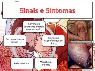 Corrimento
abundante amarelo
ou esverdeado;
Prurido na
vagina/pênis/e ou
ânus;
Mau cheiro,
bolhas;
Ardor ao urinar;
Dor durante o ato
sexual;
 
