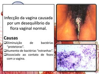 Infecção da vagina causada
por um desequilíbrio da
flora vaginal normal.
Causas
Diminuição de bactérias
“protetoras”.
Aumento de bactérias “estranhas”.
Associado ao contato de fezes
com a vagina.
 