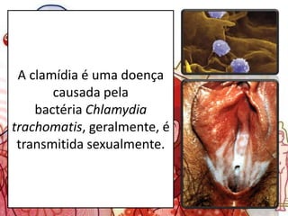 A clamídia é uma doença
causada pela
bactéria Chlamydia
trachomatis, geralmente, é
transmitida sexualmente.
 