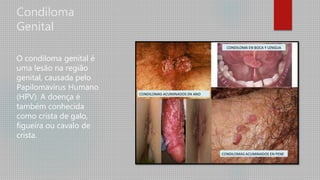 Condiloma
Genital
O condiloma genital é
uma lesão na região
genital, causada pelo
Papilomavirus Humano
(HPV). A doença é
também conhecida
como crista de galo,
figueira ou cavalo de
crista.
 