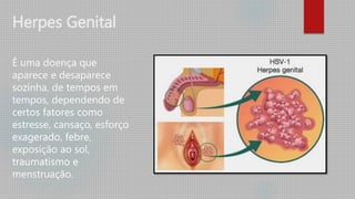 Herpes Genital
É uma doença que
aparece e desaparece
sozinha, de tempos em
tempos, dependendo de
certos fatores como
estresse, cansaço, esforço
exagerado, febre,
exposição ao sol,
traumatismo e
menstruação.
 