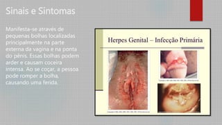 Sinais e Sintomas
Manifesta-se através de
pequenas bolhas localizadas
principalmente na parte
externa da vagina e na ponta
do pênis. Essas bolhas podem
arder e causam coceira
intensa. Ao se coçar, a pessoa
pode romper a bolha,
causando uma ferida.
 