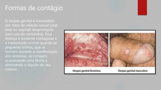 Formas de contágio
O herpes genital é transmitido
por meio de relação sexual (oral,
anal ou vaginal) desprotegida
(sem uso da camisinha). Essa
doença é bastante contagiosa e
a transmissão ocorre quando as
pequenas bolhas, que se
formam durante a manifestação
dos sintomas, se rompem,
ocasionando uma ferida e
eliminando o líquido do seu
interior.
 