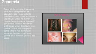 Doença infecto-contagiosa que se
caracteriza pela presença de
abundante secreção purulenta
(corrimento) pela uretra no homem e
vagina e/ou uretra na mulher. Este
quadro frequentemente é precedido
por prurido (coceira) na uretra e
ardência ao urinar. Em alguns casos
podem ocorrer sintomas gerais,
como a febre. Nas mulheres os
sintomas são mais brandos ou
podem estar ausentes (maioria dos
casos).
Gonorréia
 