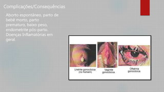 Complicações/Consequências
Aborto espontâneo, parto de
bebê morto, parto
prematuro, baixo peso,
endometrite pós-parto.
Doenças Inflamatórias em
geral.
 
