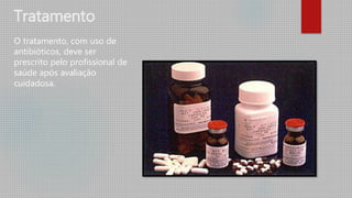 Tratamento
O tratamento, com uso de
antibióticos, deve ser
prescrito pelo profissional de
saúde após avaliação
cuidadosa.
 
