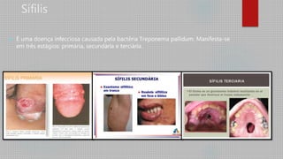 Sífilis
 É uma doença infecciosa causada pela bactéria Treponema pallidum. Manifesta-se
em três estágios: primária, secundária e terciária.
 