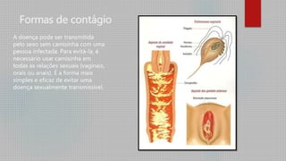 Formas de contágio
A doença pode ser transmitida
pelo sexo sem camisinha com uma
pessoa infectada. Para evitá-la, é
necessário usar camisinha em
todas as relações sexuais (vaginais,
orais ou anais). É a forma mais
simples e eficaz de evitar uma
doença sexualmente transmissível.
 