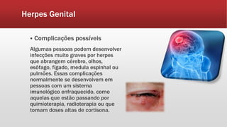 Herpes Genital
 Complicações possíveis
Algumas pessoas podem desenvolver
infecções muito graves por herpes
que abrangem cérebro, olhos,
esôfago, fígado, medula espinhal ou
pulmões. Essas complicações
normalmente se desenvolvem em
pessoas com um sistema
imunológico enfraquecido, como
aquelas que estão passando por
quimioterapia, radioterapia ou que
tomam doses altas de cortisona.
 