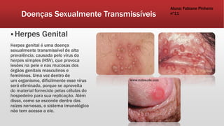 Doenças Sexualmente Transmissíveis
 Herpes Genital
Herpes genital é uma doença
sexualmente transmissível de alta
prevalência, causada pelo vírus do
herpes simples (HSV), que provoca
lesões na pele e nas mucosas dos
órgãos genitais masculinos e
femininos. Uma vez dentro de
um organismo, dificilmente esse vírus
será eliminado, porque se aproveita
do material fornecido pelas células do
hospedeiro para sua replicação. Além
disso, como se esconde dentro das
raízes nervosas, o sistema imunológico
não tem acesso a ele.
Aluna: Fabiane Pinheiro
nº11
 