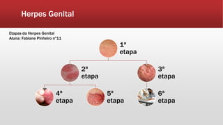 Herpes Genital
1ª
etapa
2ª
etapa
4ª
etapa
5ª
etapa
3ª
etapa
6ª
etapa
Etapas da Herpes Genital
Aluna: Fabiane Pinheiro nº11
 
