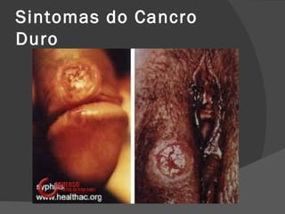 Sintomas do Cancro
Duro
 