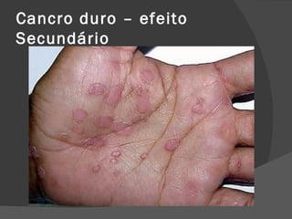 Cancro duro – efeito
Secundário
 