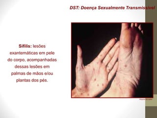 DST: Doença Sexualmente Transmissível
Sífilis: lesões
exantemáticas em pele
do corpo, acompanhadas
dessas lesões em
palmas de mãos e/ou
plantas dos pés.
Arquivo do autor
 